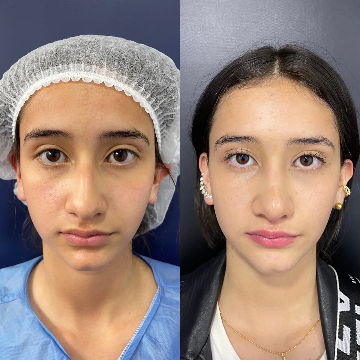 Resultados de rinoplastia antes y después, remodelación nasal natural en la clínica