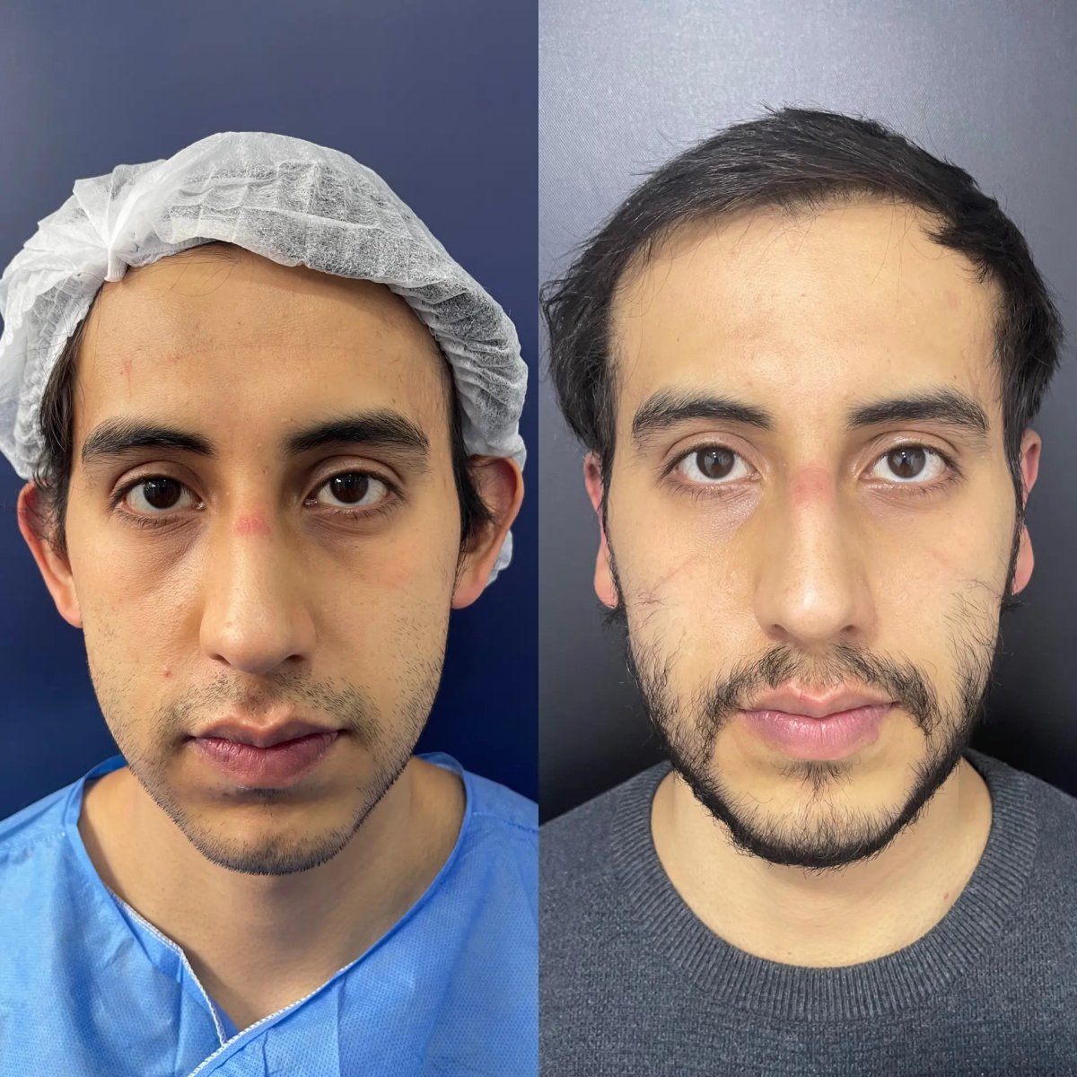 Resultados de rinoplastia antes y después, remodelación nasal para armonía facial