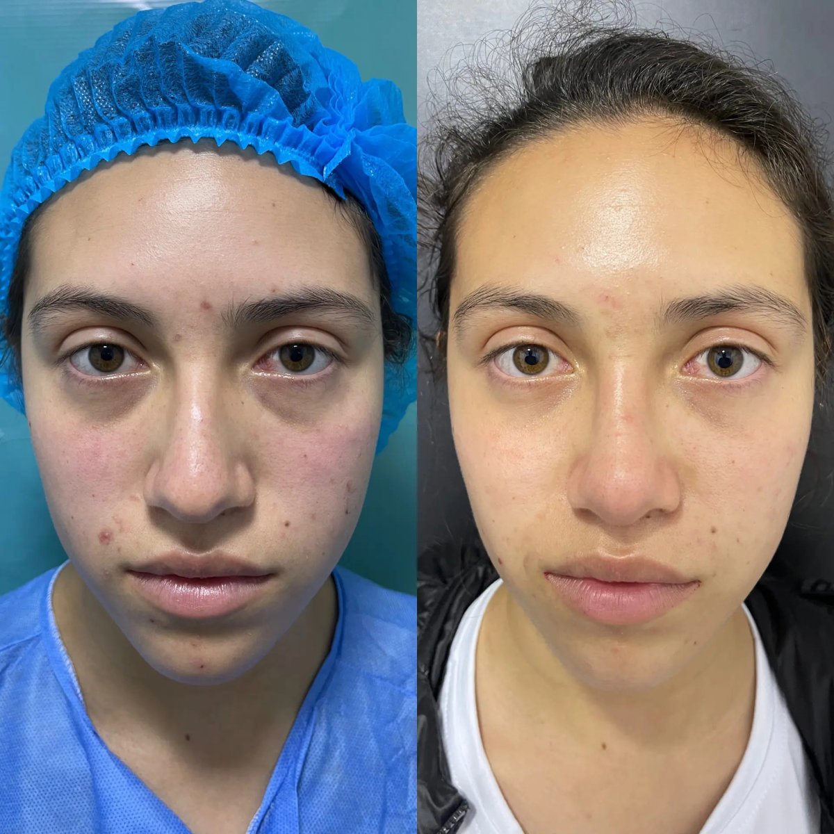 Resultados de rinoplastia antes y después, remodelación nasal natural en la clínica