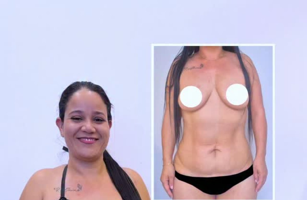 Resultados de abdominoplastia antes y después, mejora visible del contorno abdominal