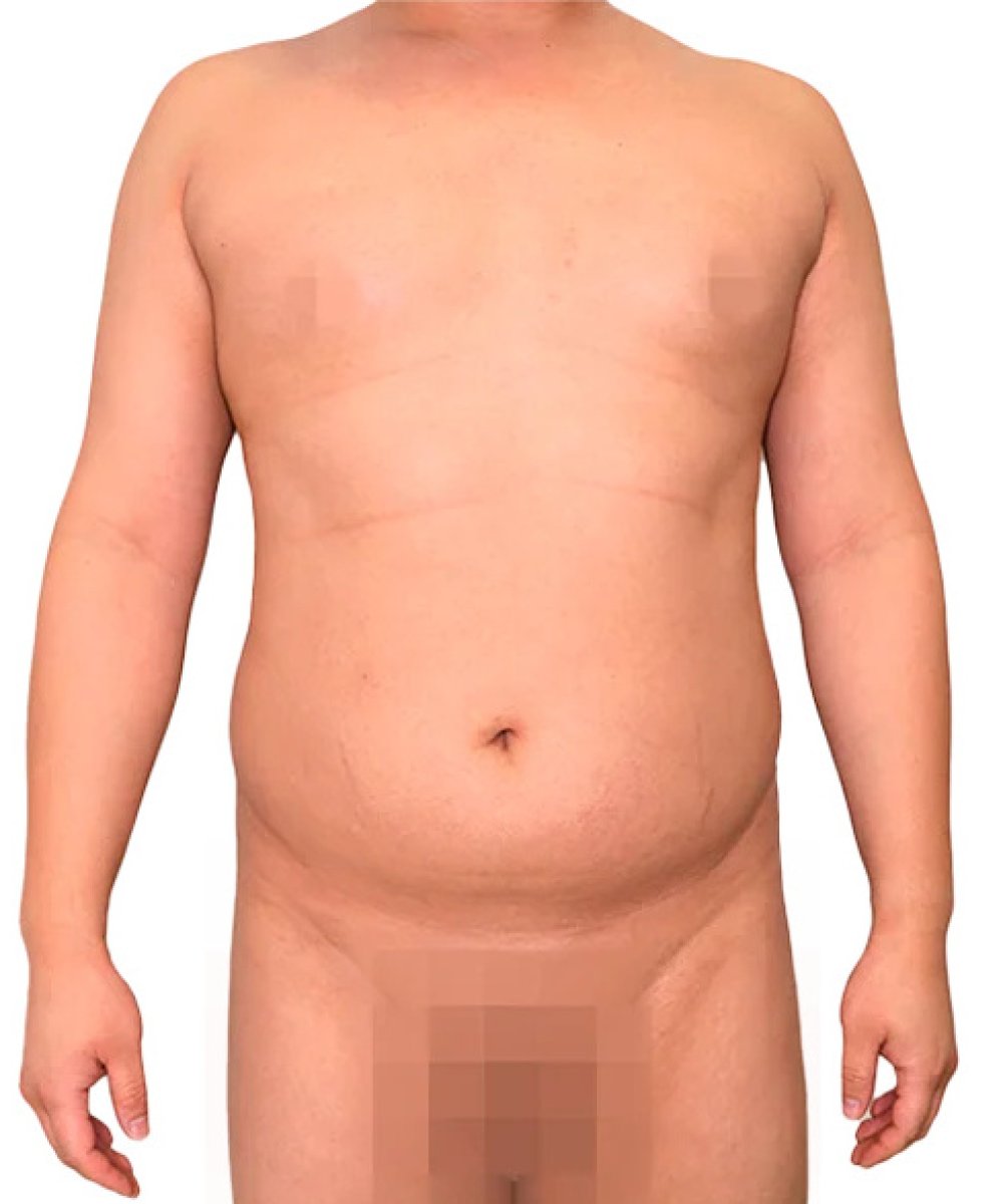 Male abdominal liposuction before result, visible fat in stomach area before procedure