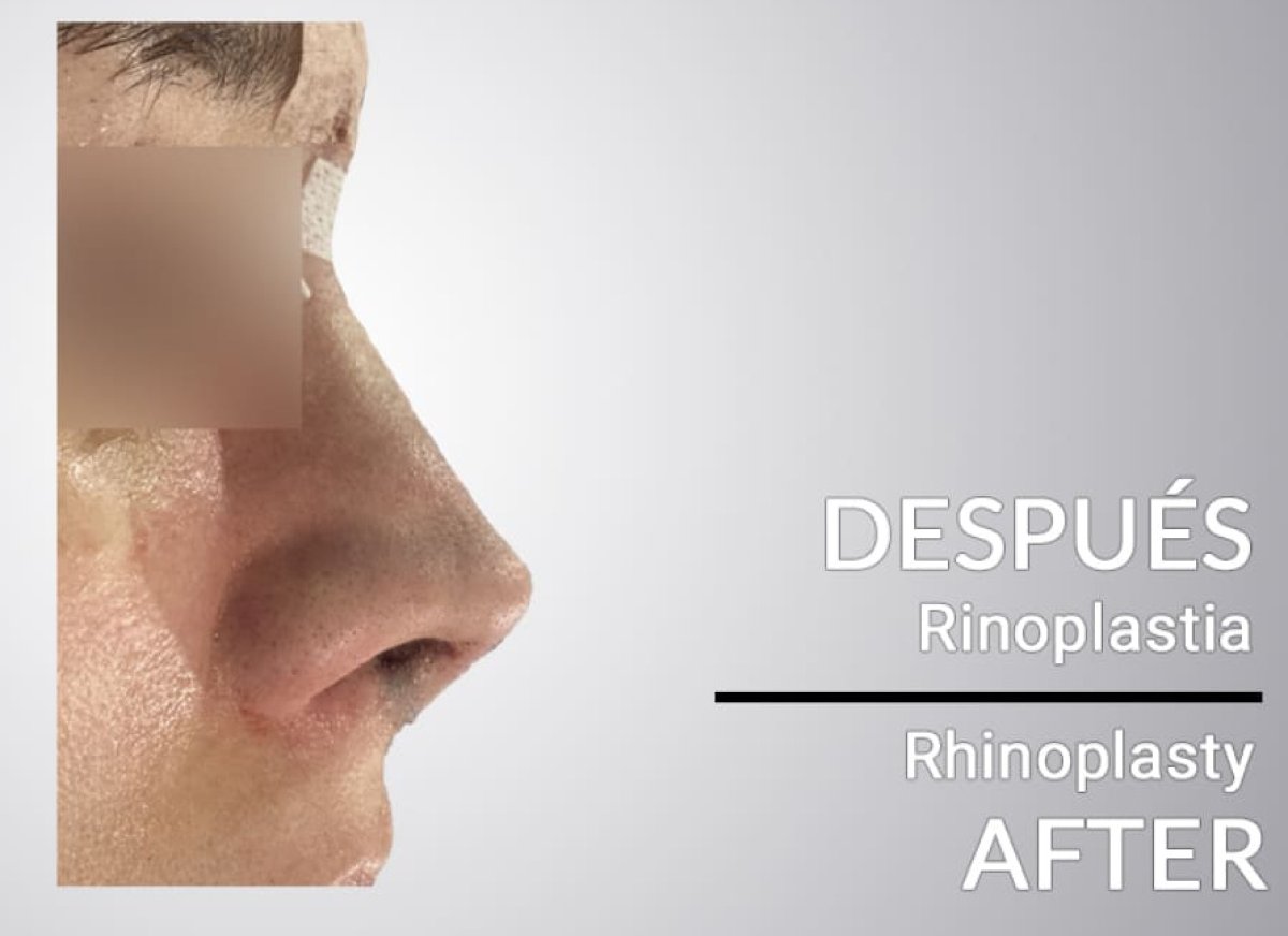 Resultado después de rinoplastia, mejora en la forma y perfil de la nariz