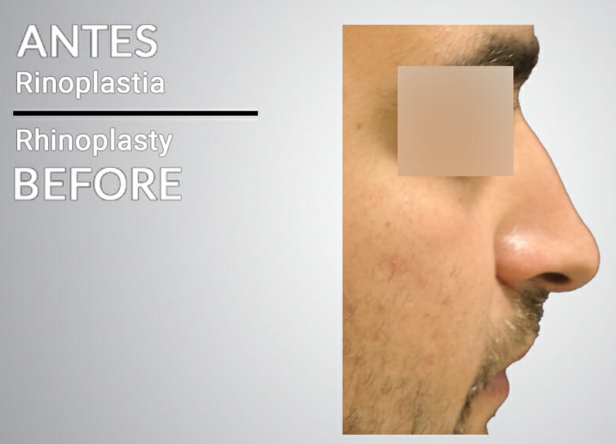 Foto antes de rinoplastia, perfil lateral masculino antes de la cirugía de nariz