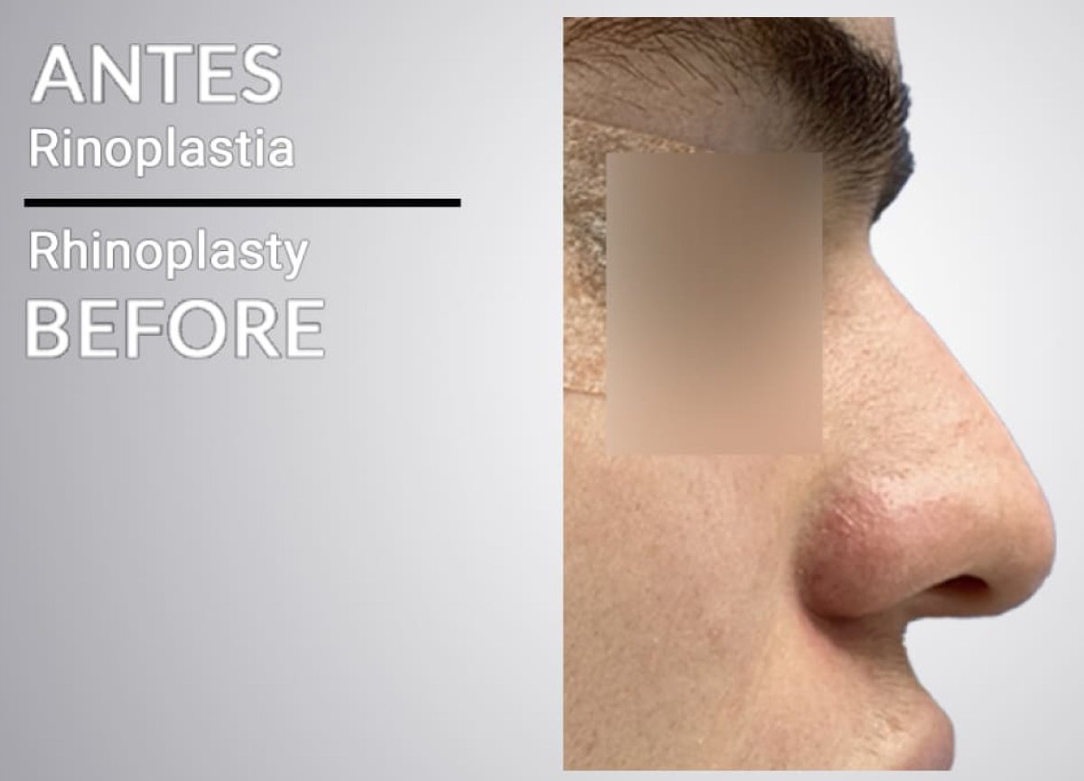 Resultado antes de rinoplastia, perfil lateral de la nariz antes del procedimiento en clínica