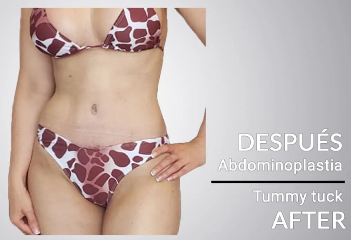Resultado después de abdominoplastia – abdomen más plano y cintura mejorada