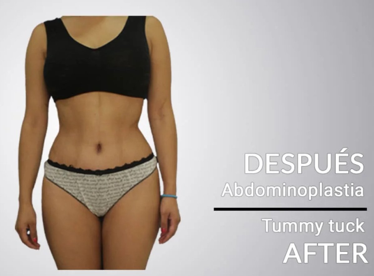 Resultado después de abdominoplastia: abdomen plano y cintura mejorada