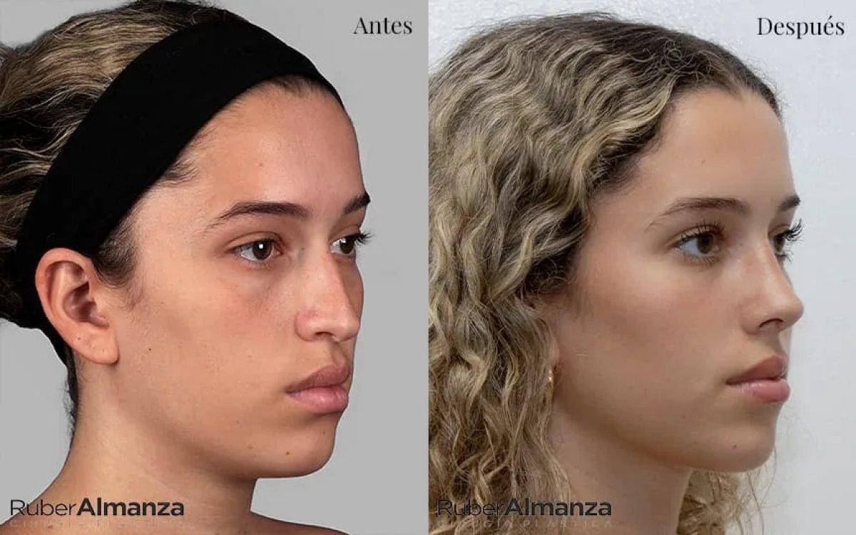 Resultados de rinoplastia antes y después en Ruber Almanza, mejora de la forma nasal