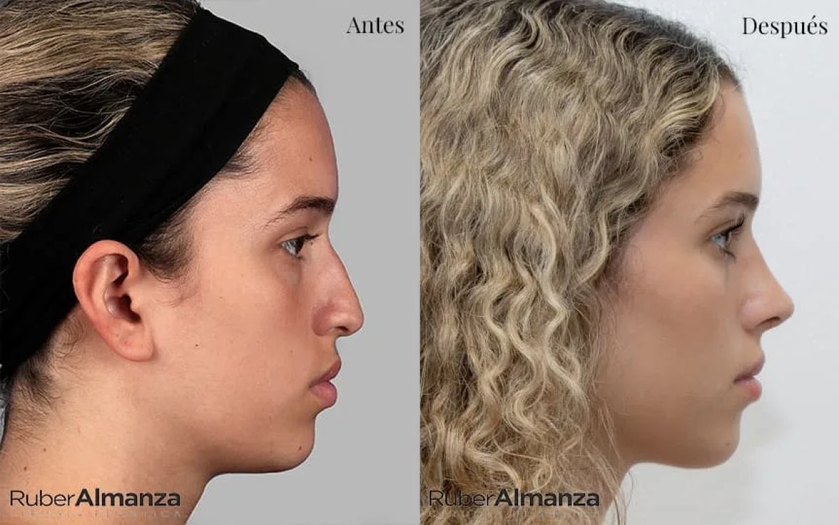 Resultados de rinoplastia antes y después en Ruber Almanza, mejora de la forma nasal