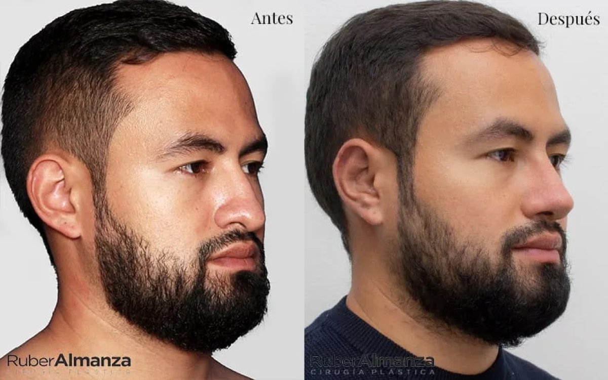 Resultados de rinoplastia antes y después en Ruber Almanza, perfil nasal mejorado en hombre