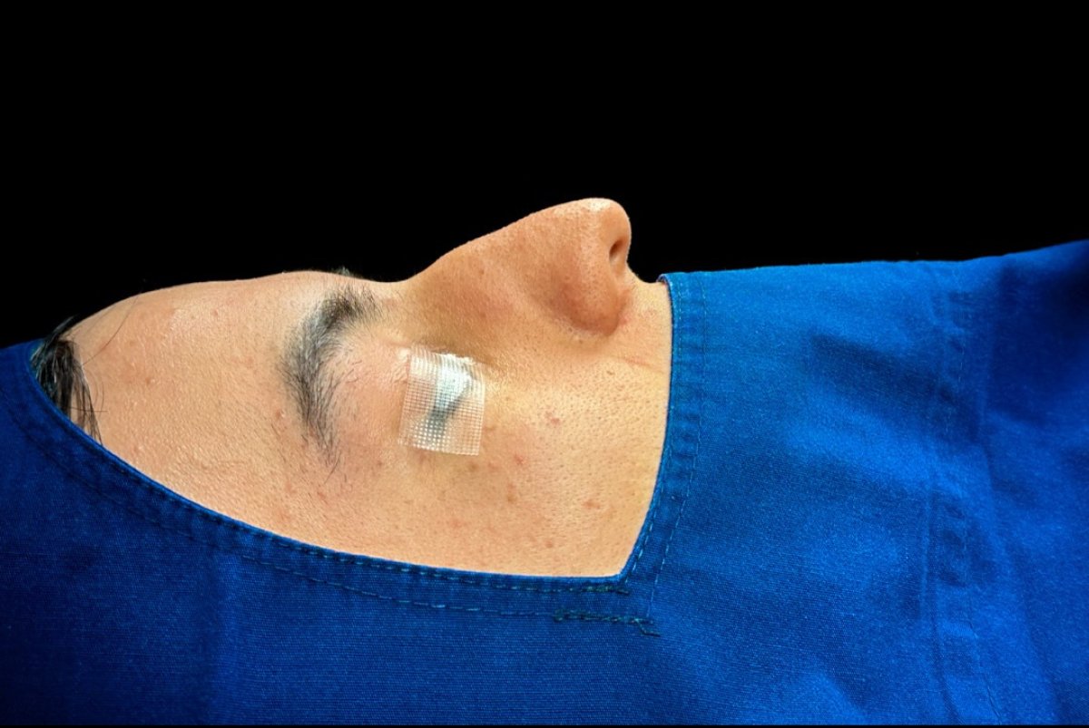 Resultado de rinoplastia tras cirugía nasal, perfil lateral muestra recuperación en clínica
