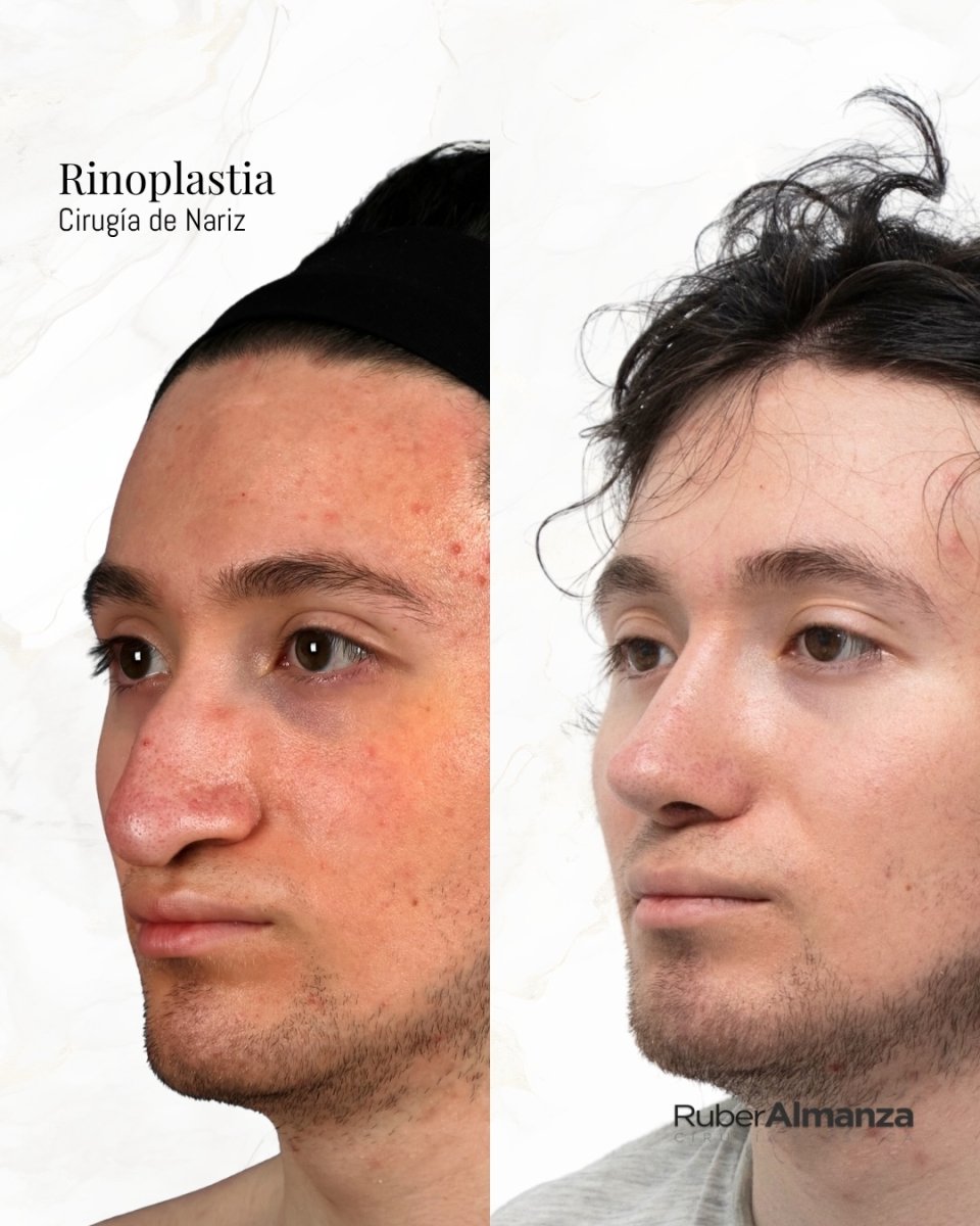 Resultados antes y después de rinoplastia de punta en Ruber Almanza – nariz refinada