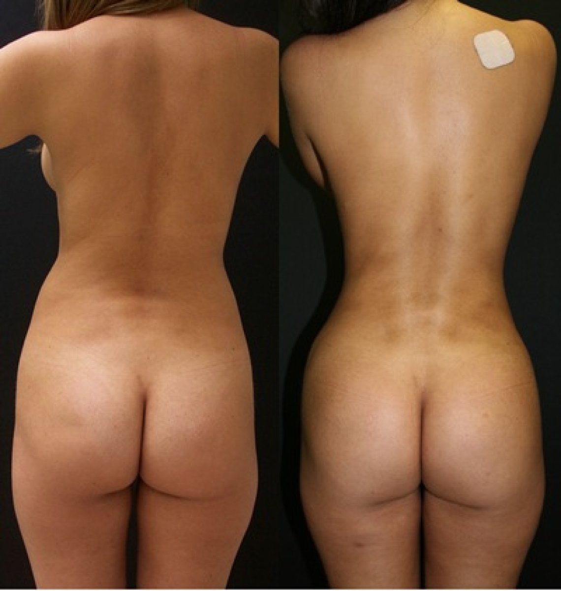 Before and after Brazilian Butt Lift results – enhanced buttock shape and contour improvement