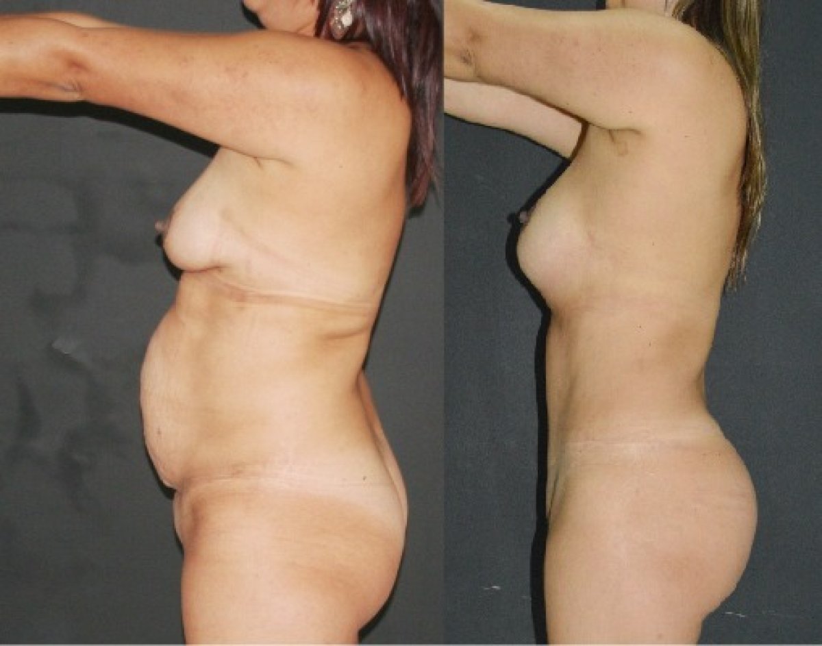Before and after tummy tuck results – visible abdominal contour improvement
