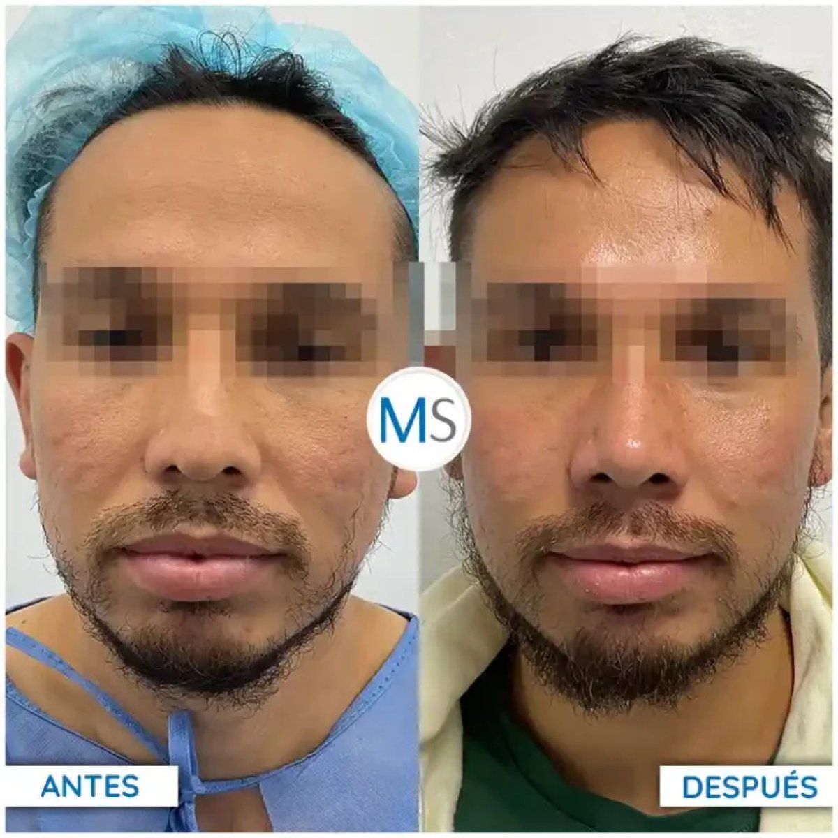 Resultados de lifting facial antes y después en paciente masculino, rejuvenecimiento visible