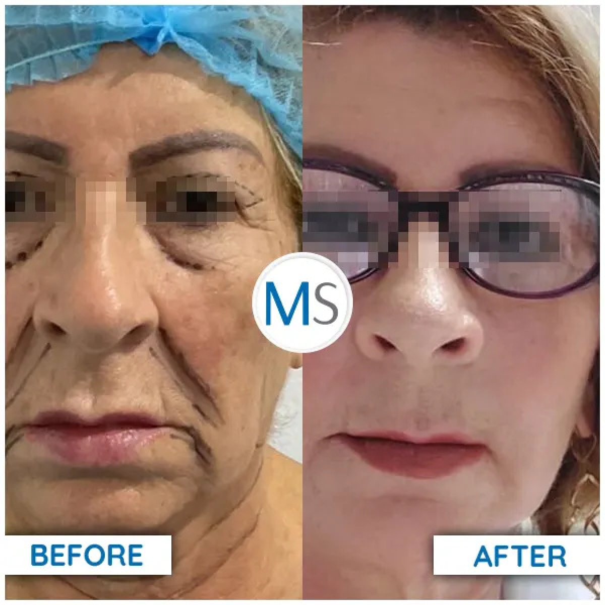 Resultados de lifting facial antes y después en clínica MS – rejuvenecimiento visible