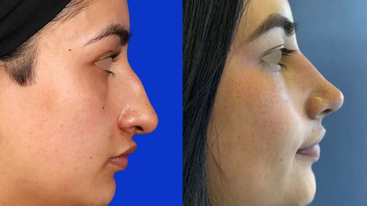 Resultados de rinoplastia antes y después, remodelación nasal con perfil natural
