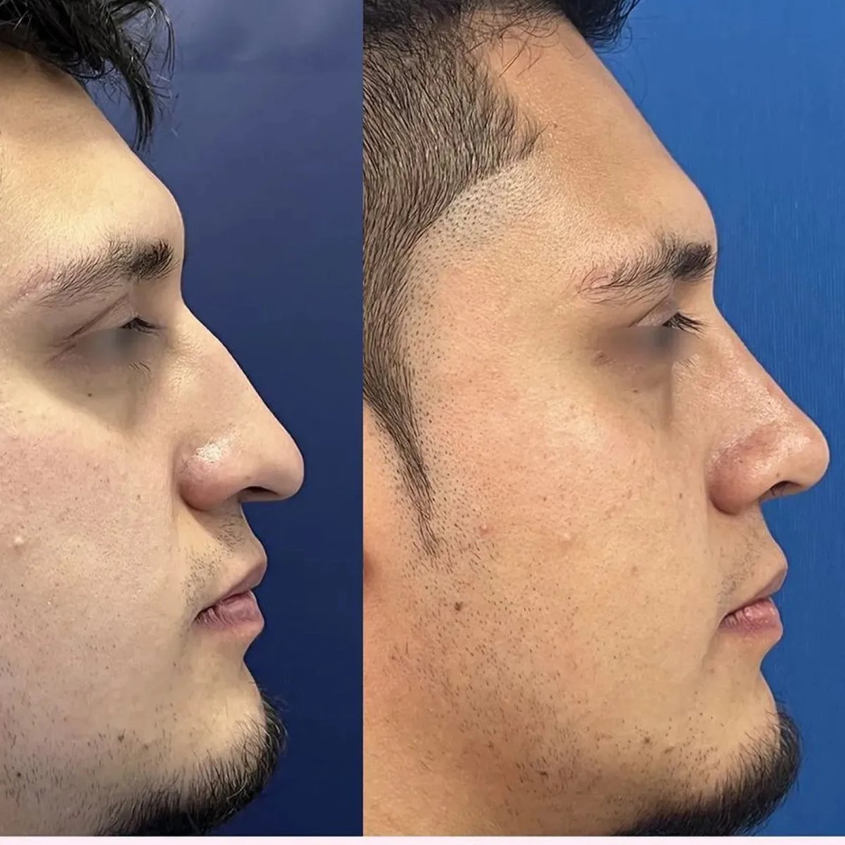 نتائج عملية تجميل الأنف قبل وبعد للرجال، تحسين طبيعي لشكل الأنف الجانبي