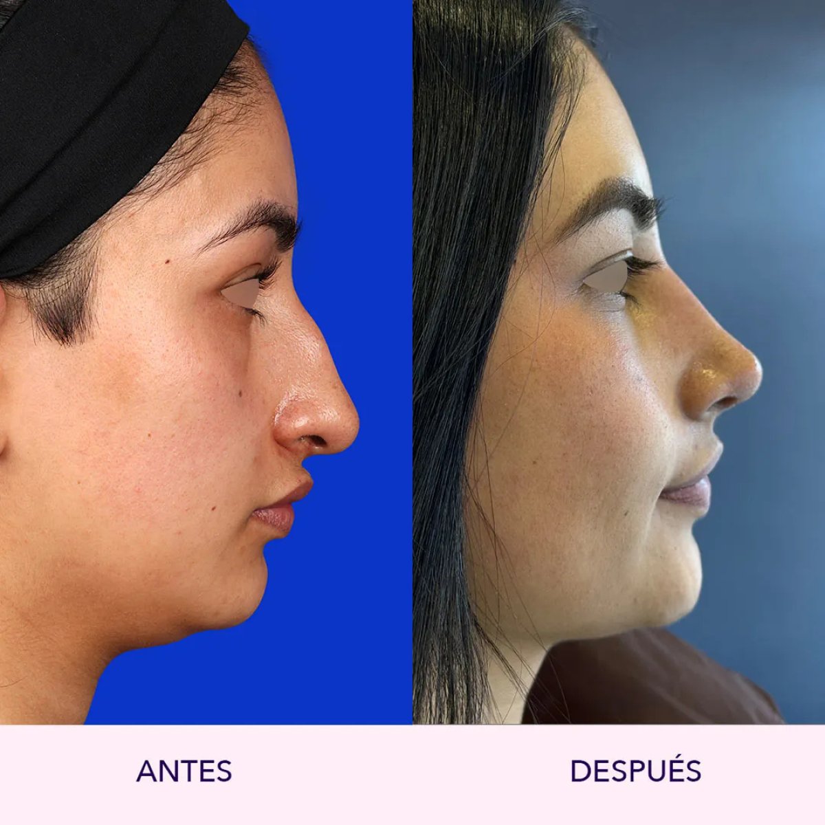 Resultados de rinoplastia antes y después, perfil y simetría nasal mejorados
