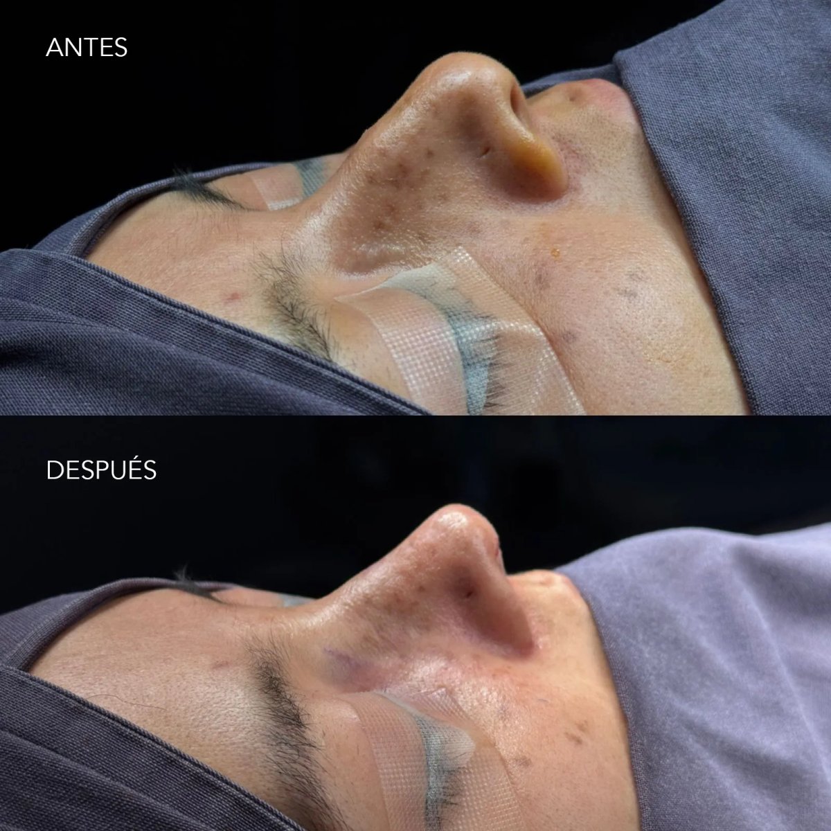 Resultados de rinoplastia antes y después, mejora de la forma y perfil nasal tras cirugía