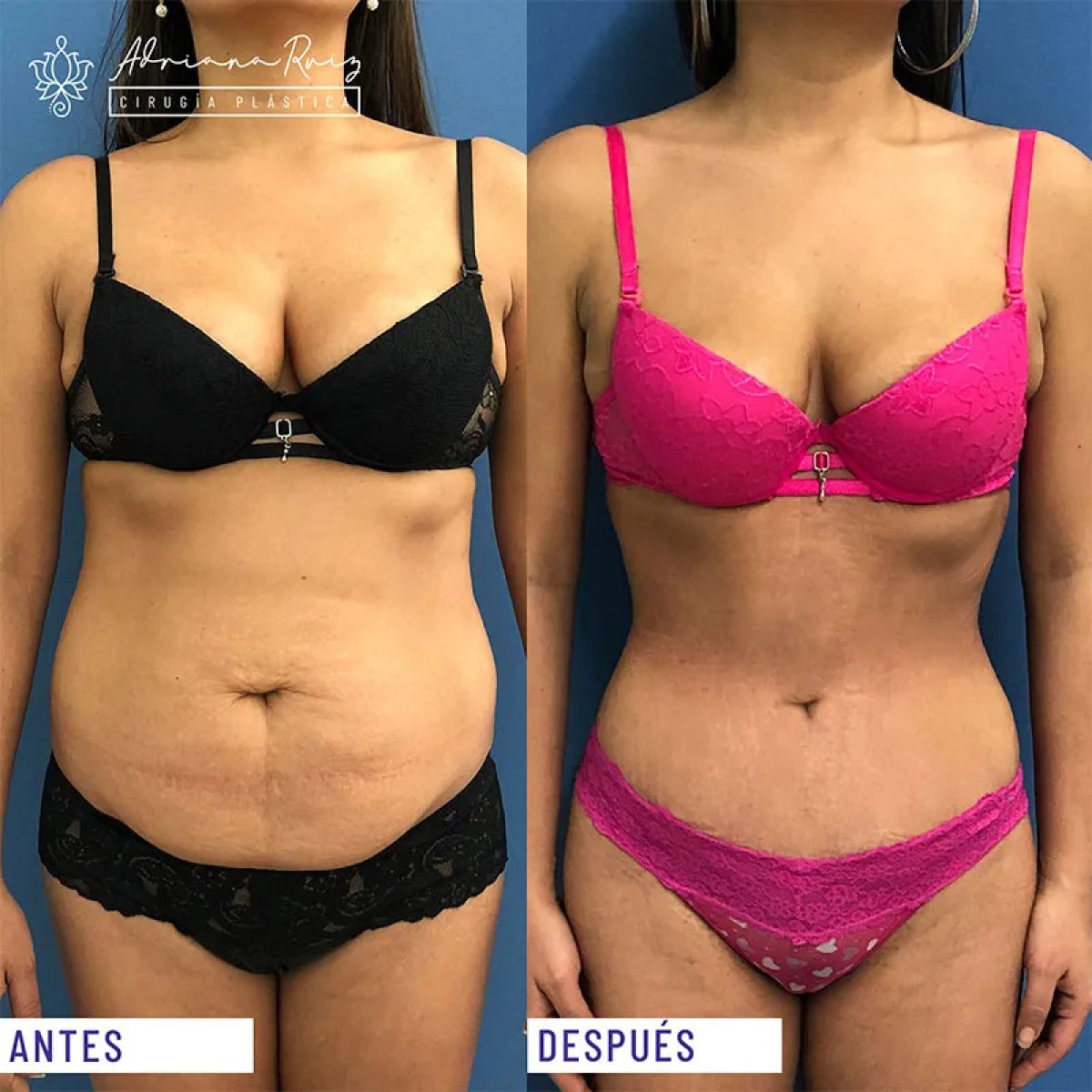 Resultados de abdominoplastia antes y después en clínica Adriana Ruiz – abdomen definido