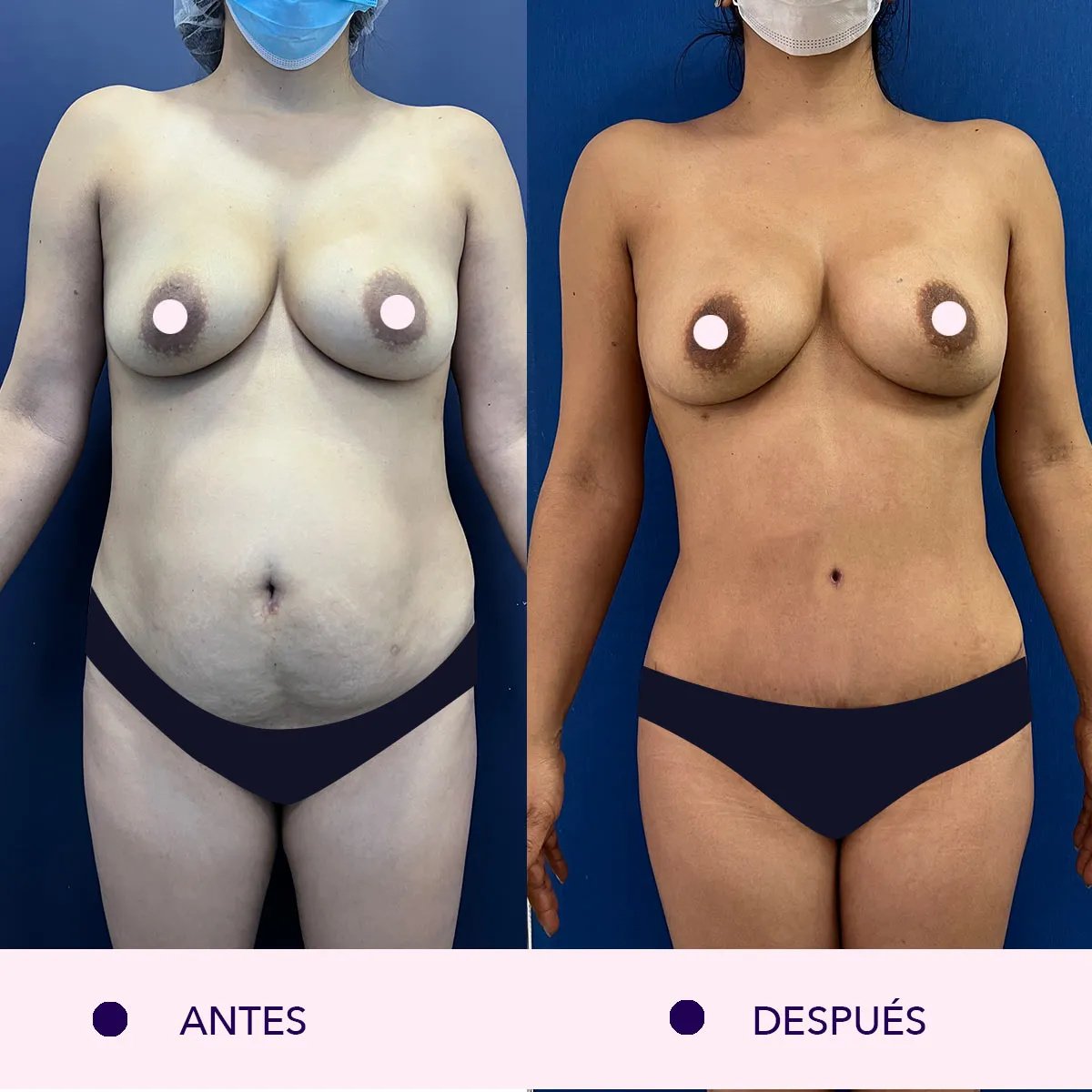 Resultados de abdominoplastia antes y después – mejora visible del contorno abdominal