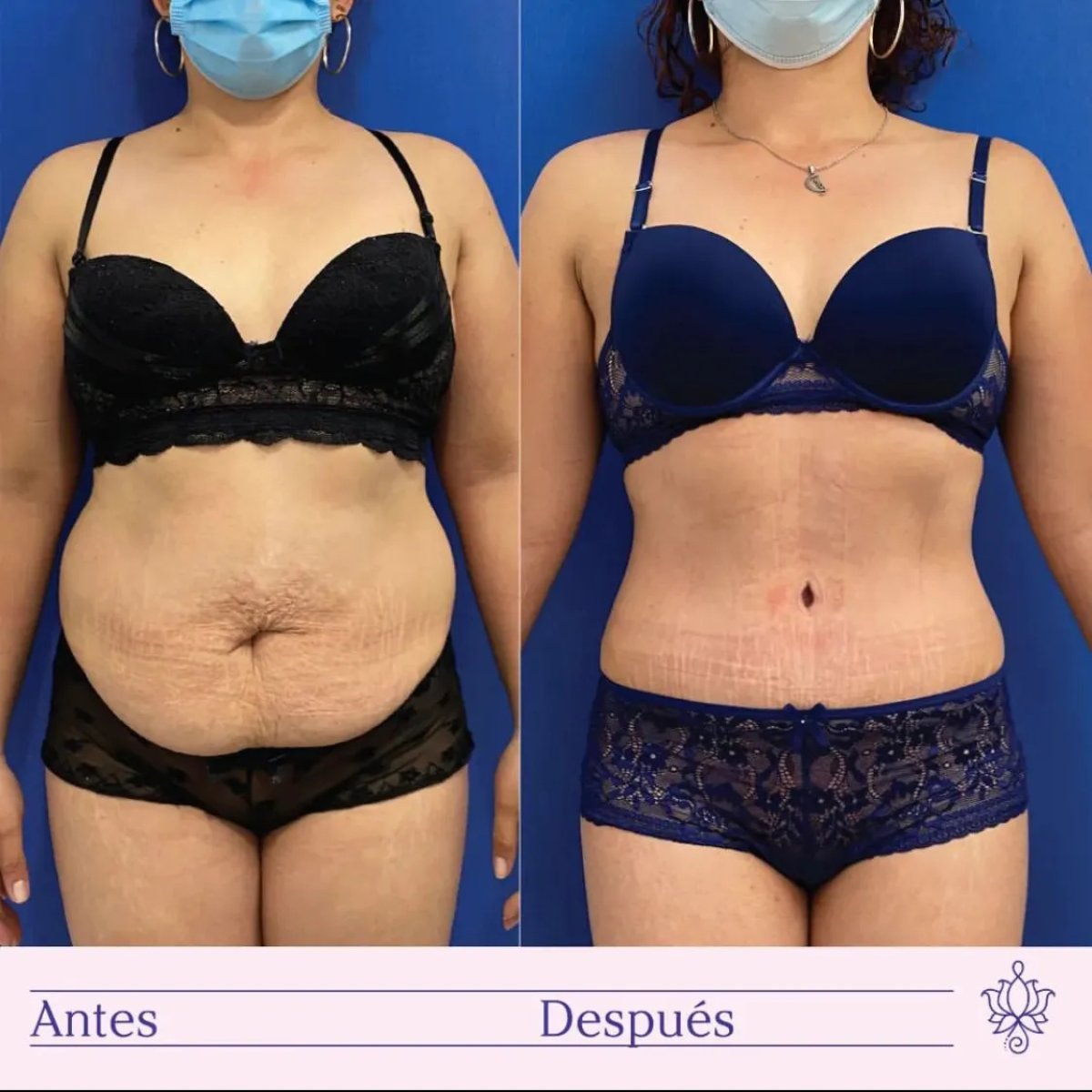 Resultados de abdominoplastia antes y después – mejora visible del contorno abdominal