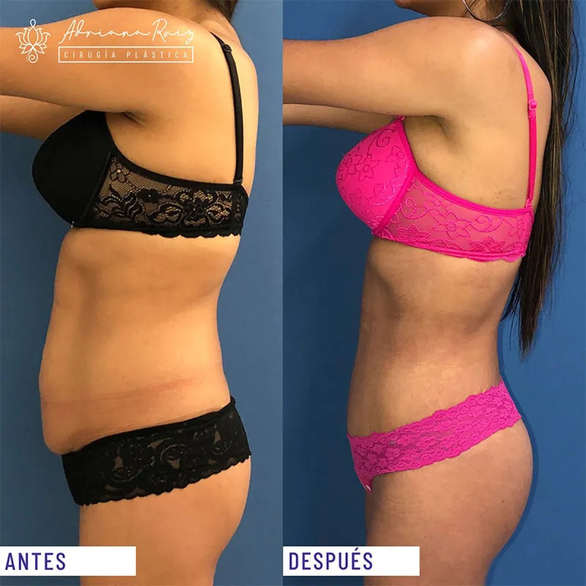 Resultados de abdominoplastia antes y después en clínica Adriana Ruiz – abdomen plano