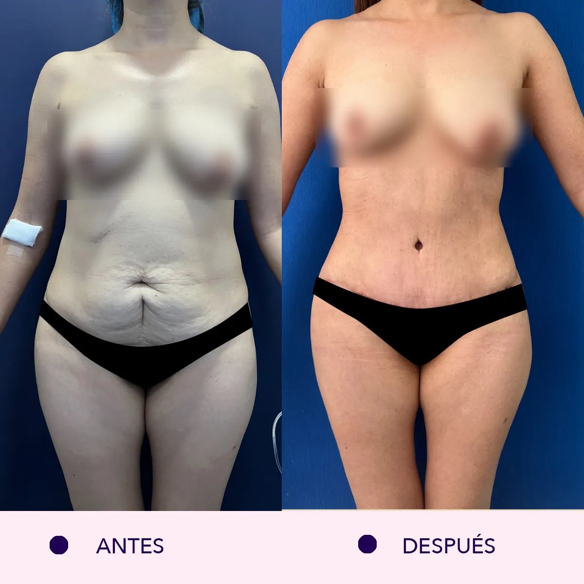 Resultados de liposucción antes y después – mejora visible del contorno corporal en mujer