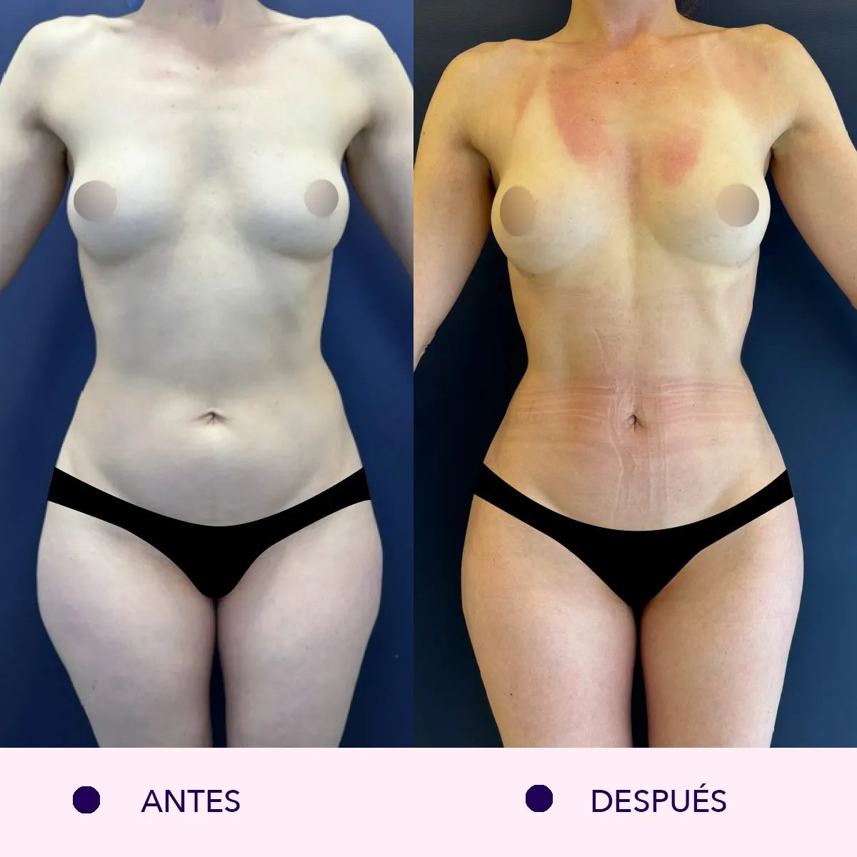 Resultados de liposucción antes y después – mejora visible del contorno de cintura y abdomen