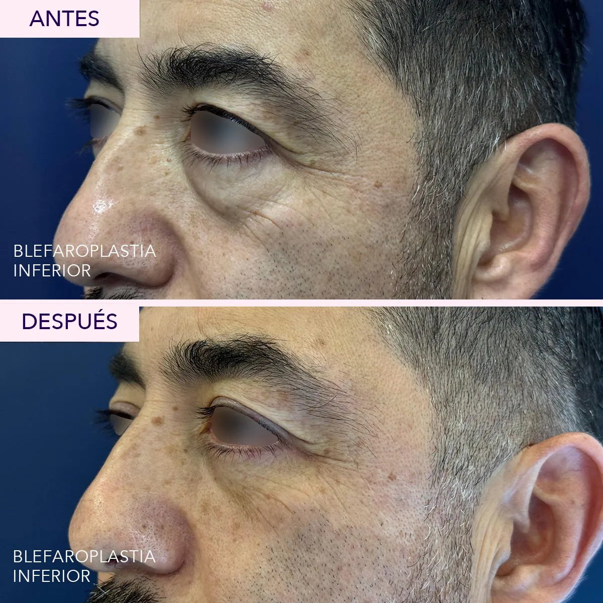 Resultados de blefaroplastia inferior antes y después – menos bolsas y piel más lisa