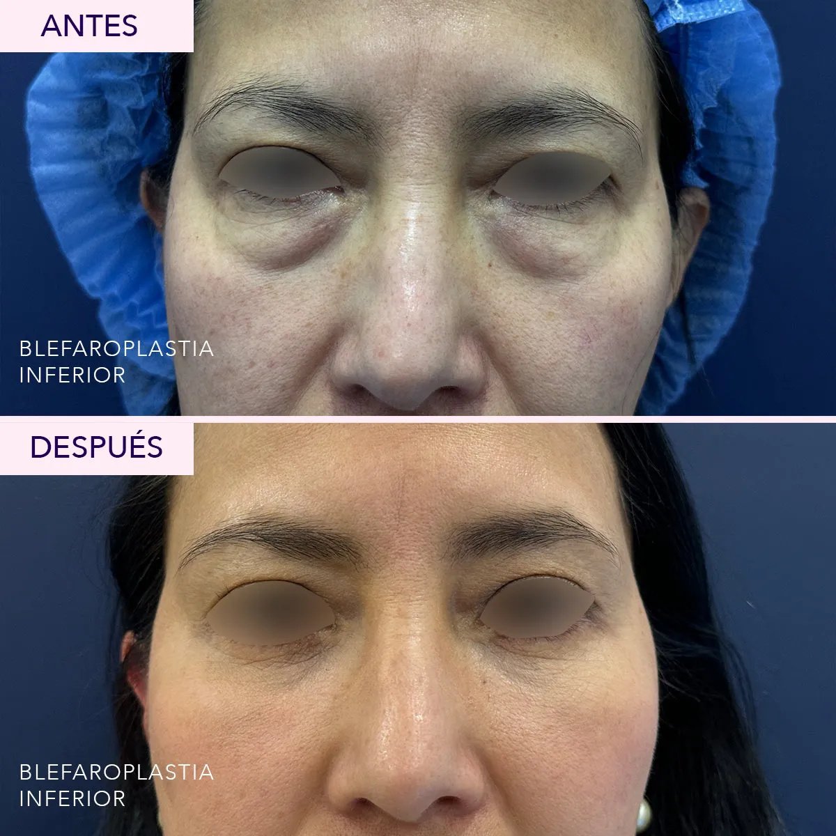 Resultados de blefaroplastia inferior antes y después – menos bolsas y piel más lisa