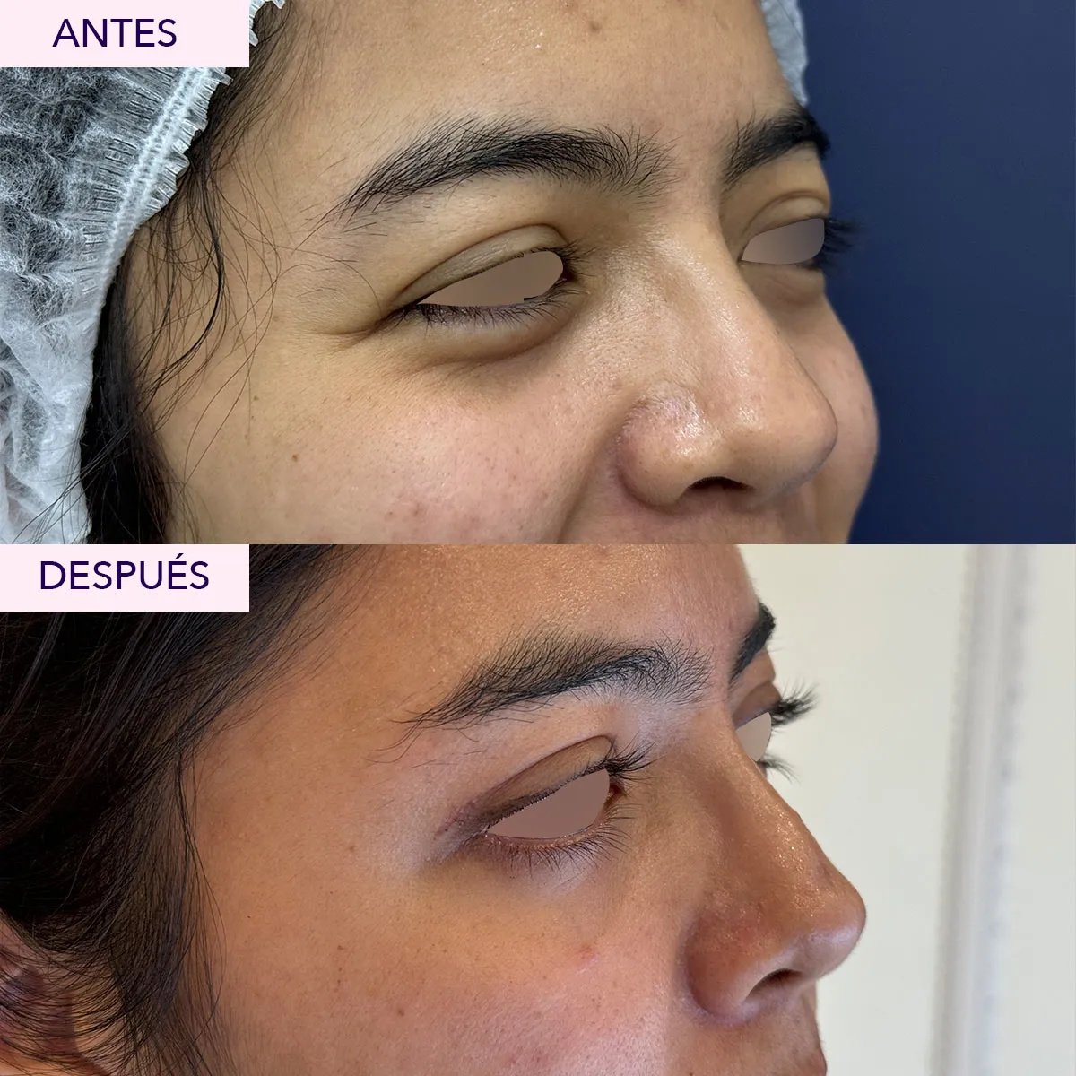Resultados de blefaroplastia antes y después, corrección de párpados con aspecto natural