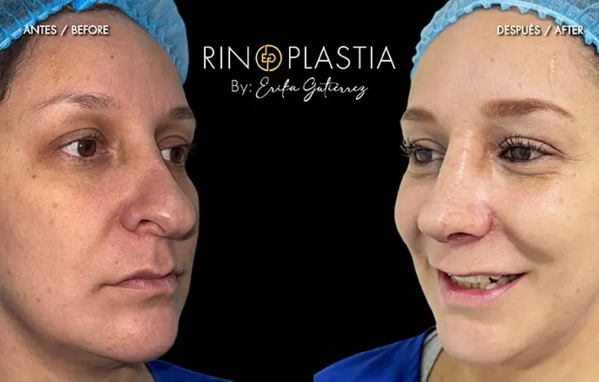 نتائج عملية تجميل الأنف قبل وبعد بواسطة إريكا غوتيريز، تحسين واضح لشكل الأنف