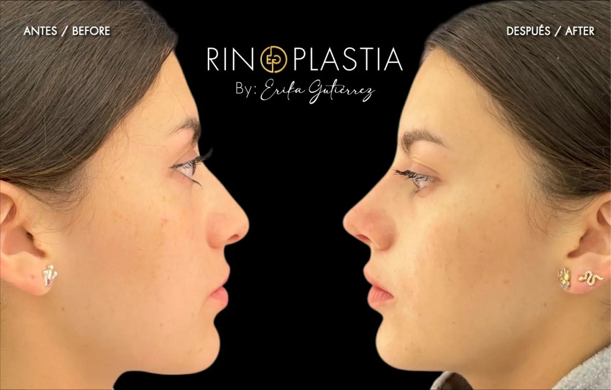 نتائج عملية تجميل الأنف قبل وبعد بواسطة إريكا غوتيريز، إعادة تشكيل طبيعية للأنف