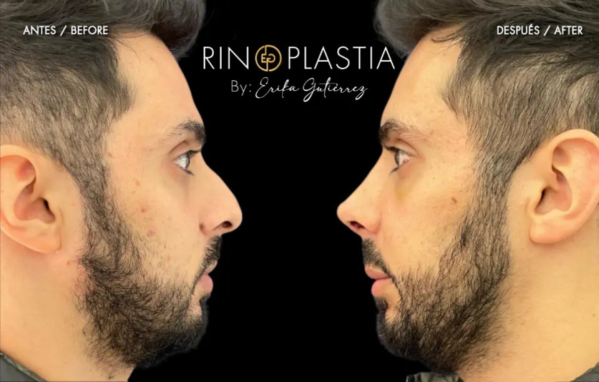 Efekty plastyki nosa przed i po u Eriki Gutierrez, widoczna poprawa kształtu nosa