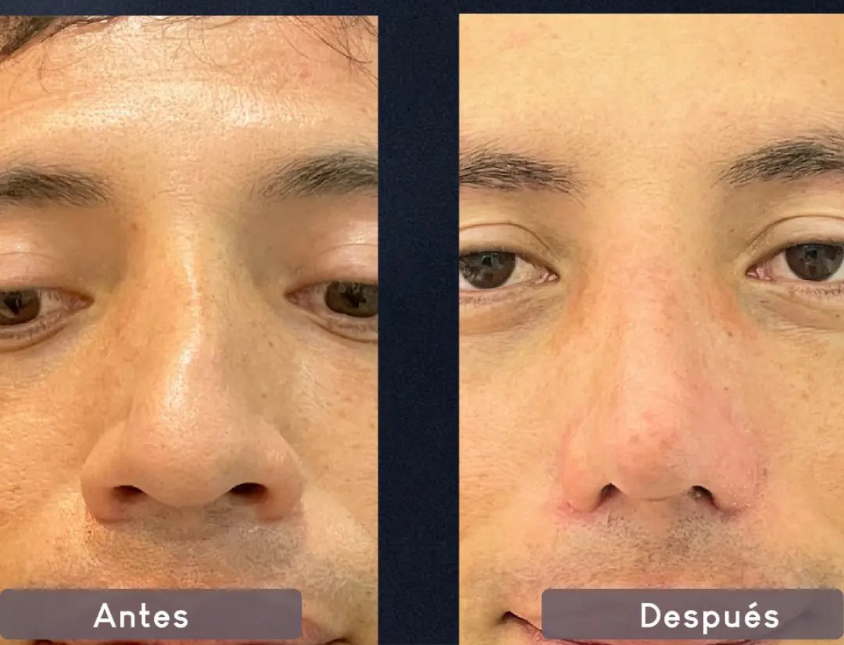 نتائج تجميل الأنف بالموجات فوق الصوتية قبل وبعد، إعادة تشكيل واضحة للأنف