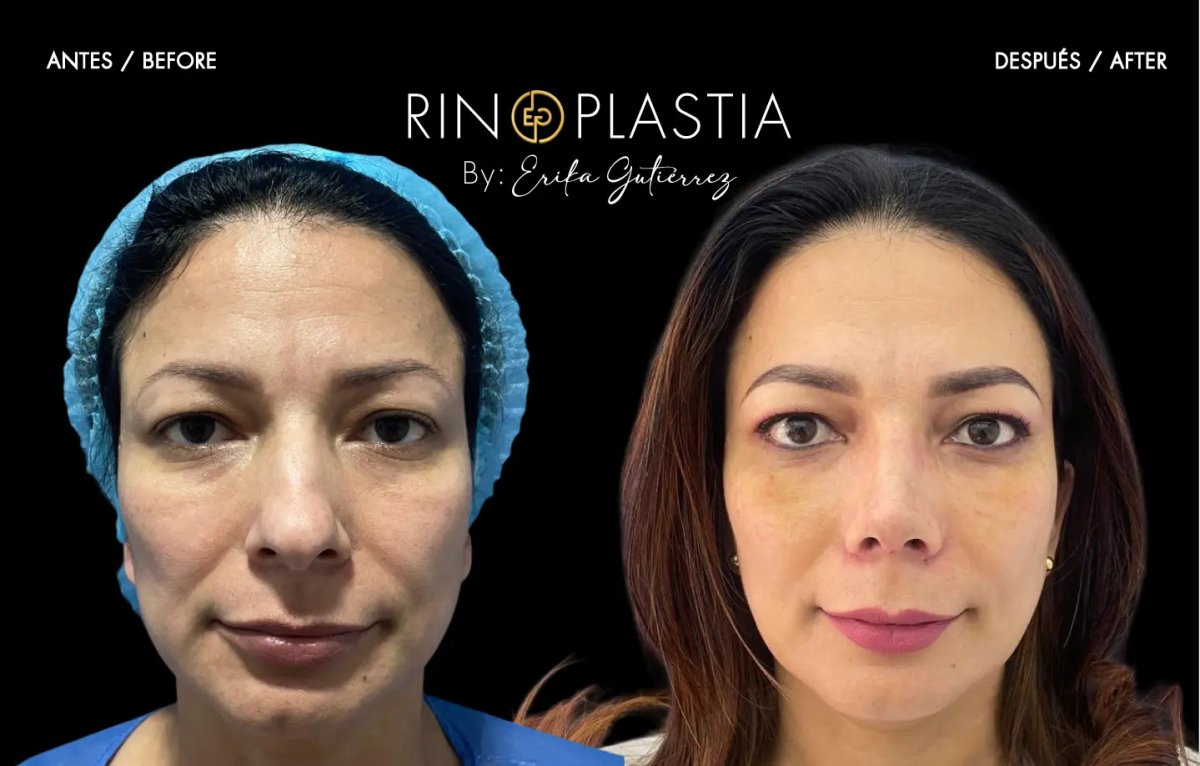 نتائج قبل وبعد تجميل طرف الأنف مع إريكا غوتيريز، إعادة تشكيل الأنف بوضوح