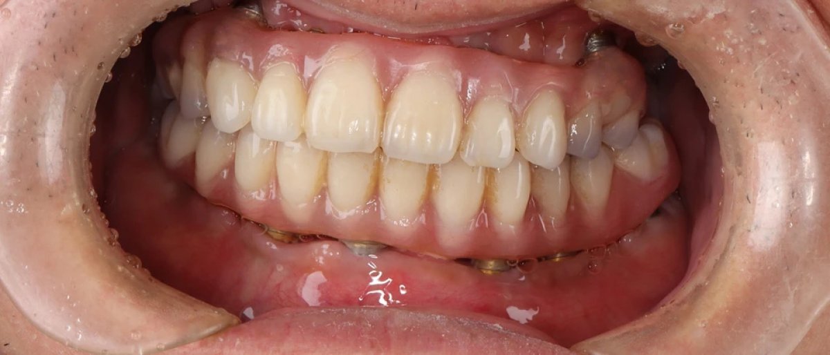 Implant-supported dental bridge result showing restored teeth and improved smile aesthetics