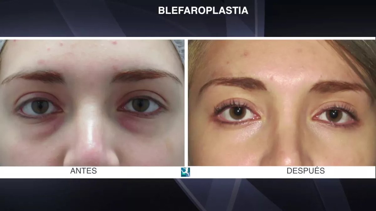 Resultados de blefaroplastia antes y después – corrección de párpados y rejuvenecimiento
