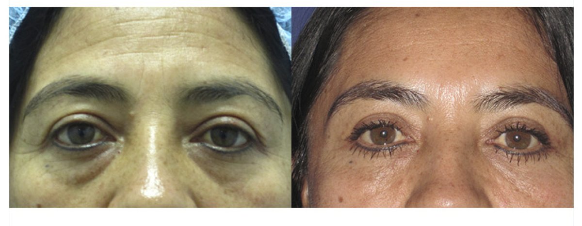 Resultados de blefaroplastia antes y después – corrección de párpados y bolsas reducidas