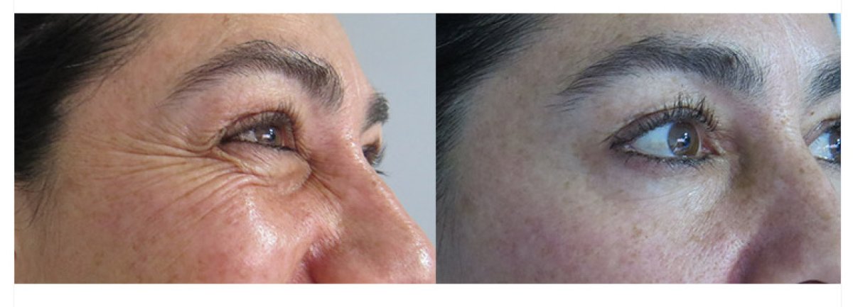 Resultados de blefaroplastia antes y después: menos arrugas y párpado más liso
