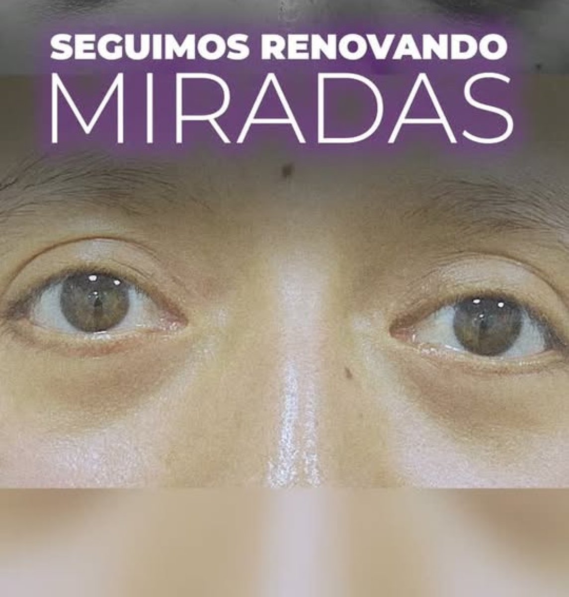 Resultado de blefaroplastia mostrando párpados rejuvenecidos y mirada renovada