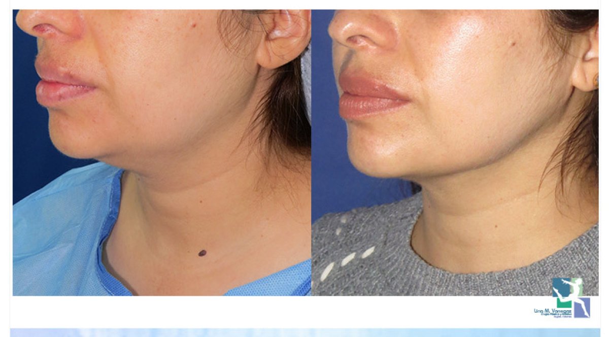 Resultados de lifting de cuello antes y después – mejor contorno de mandíbula y cuello en clínica