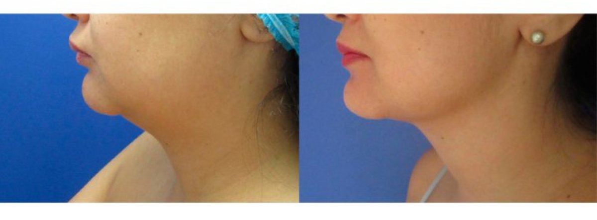 Resultados de liposucción de papada antes y después, contorno de mandíbula mejorado