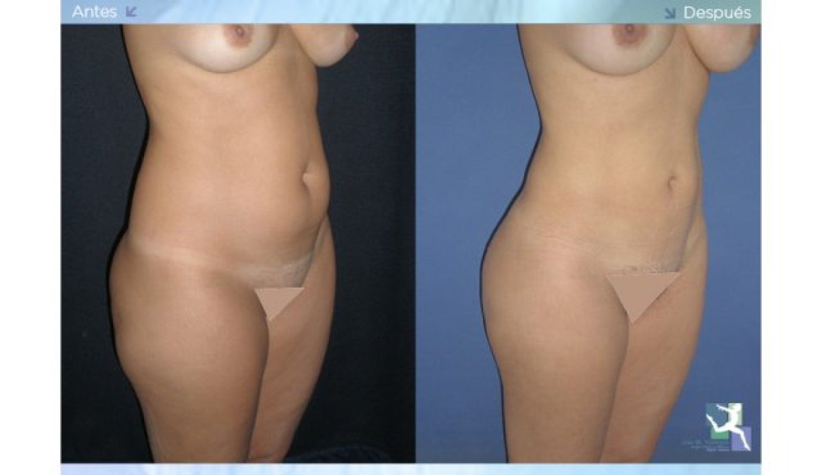Resultados de liposucción antes y después: mejora visible del contorno abdominal en mujer