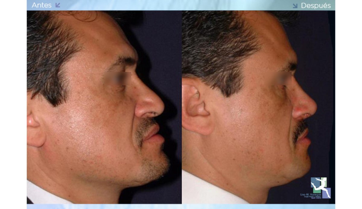 Resultados de rinoplastia antes y después en hombre, remodelación nasal natural