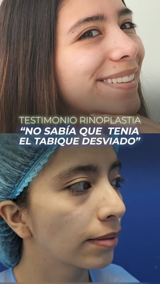 Resultados de rinoplastia antes y después para corregir tabique desviado y perfil nasal