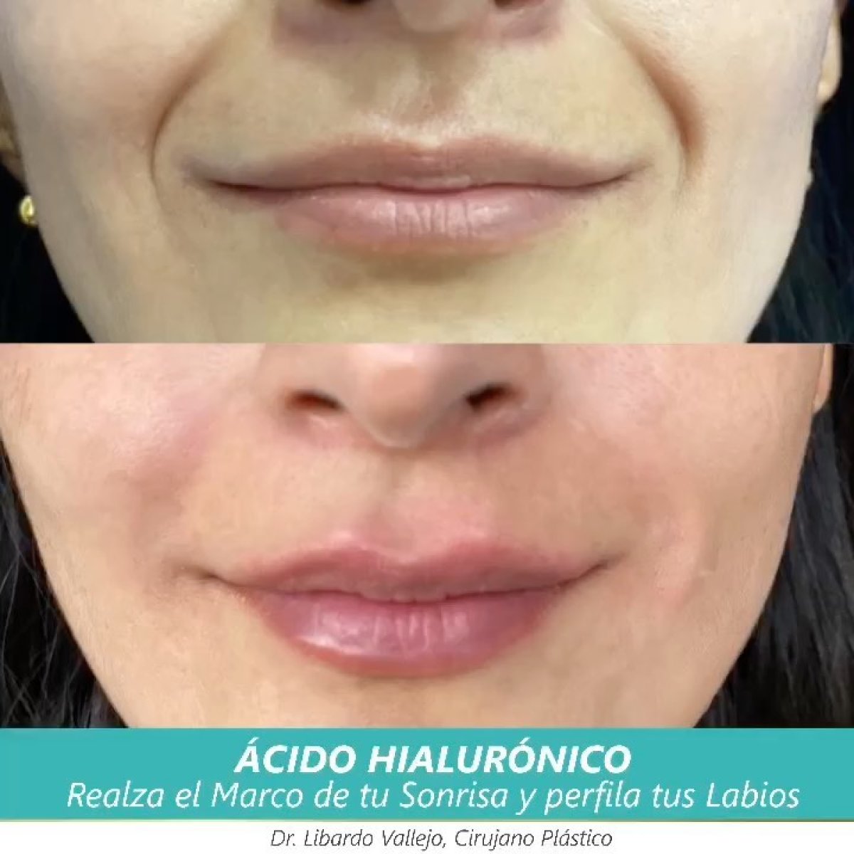 Before and after hyaluronic acid fillers result – enhanced lip contour and volume