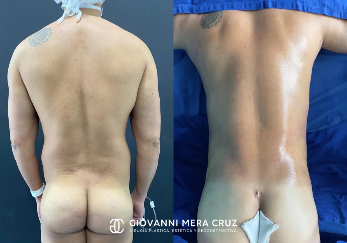 نتائج شفط الدهون قبل وبعد في عيادة Giovanni Mera Cruz – تحسين شكل الظهر