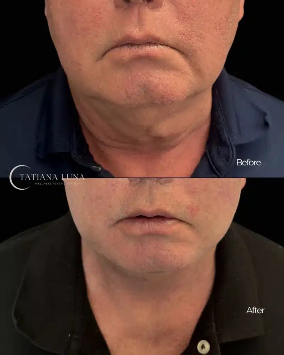 Resultados antes y después de deep plane facelift en Tatiana Luna Clinic – mejora de la mandíbula